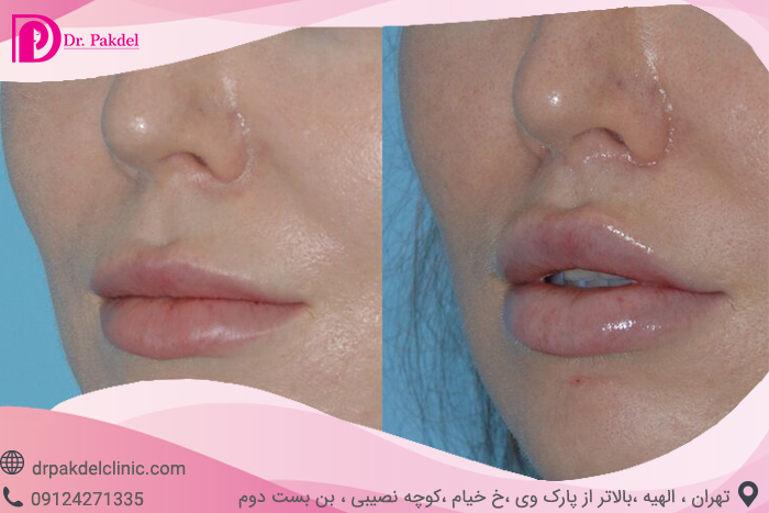 لیفت سانترال لب, جراحی بالا کشیدن لب, Central lip lift